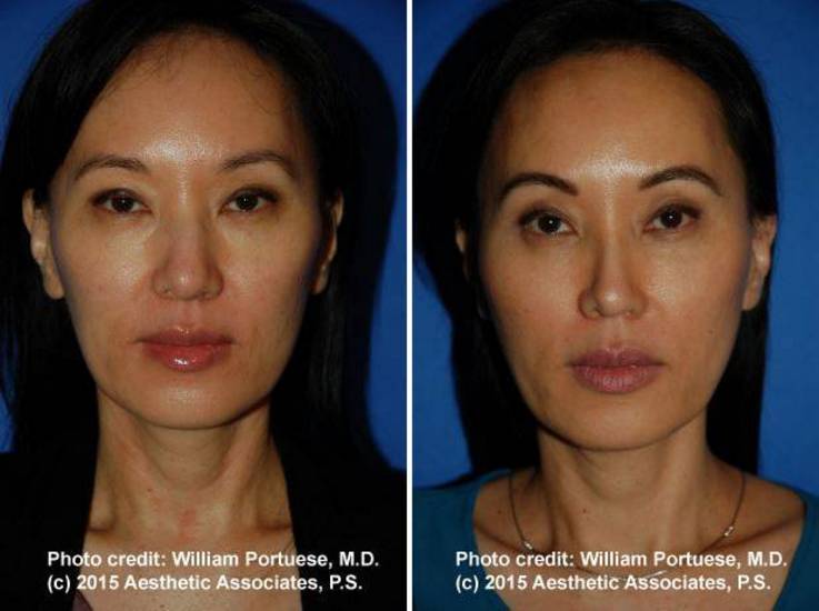 rhinoplasty washington state